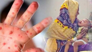 হাম উপসর্গে আরও পাঁচ শিশুর মৃত্যু, একদিনে আক্রান্ত ১৪১১