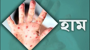 হামের উপসর্গে একদিনে ৫ জনের মৃত্যু
