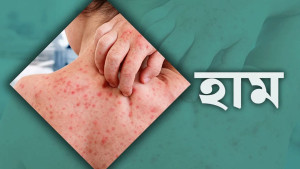 হামের উপসর্গের আরও ৪ শিশুর প্রাণহানি, মৃত্যুসংখ্যা ৭০০ ছাড়াল